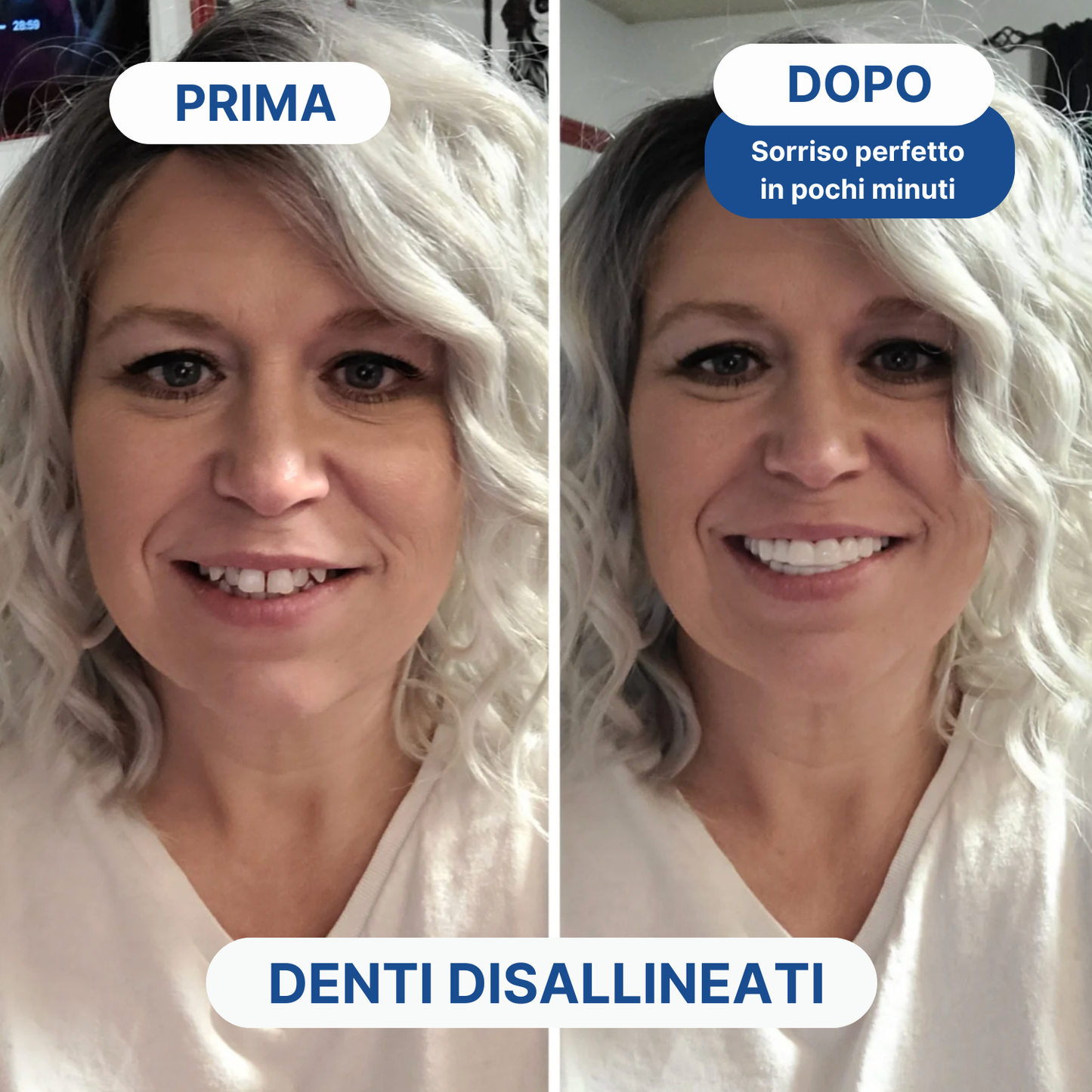 Faccette Dentali Personalizzate – Removibili e su Misura