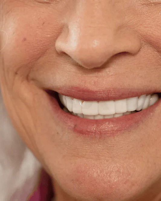 TUTTO QUELLO CHE DEVI SAPERE SULLE FACCETTE DENTALI REMOVIBILI