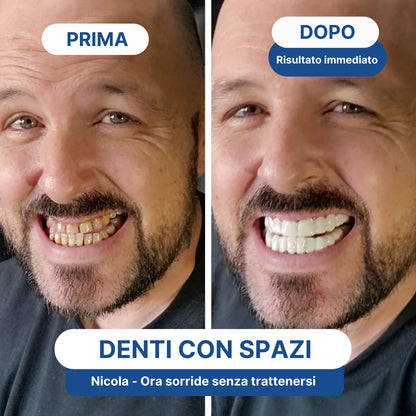 Faccette Dentali Personalizzate – Il Sorriso Che Hai Sempre Desiderato