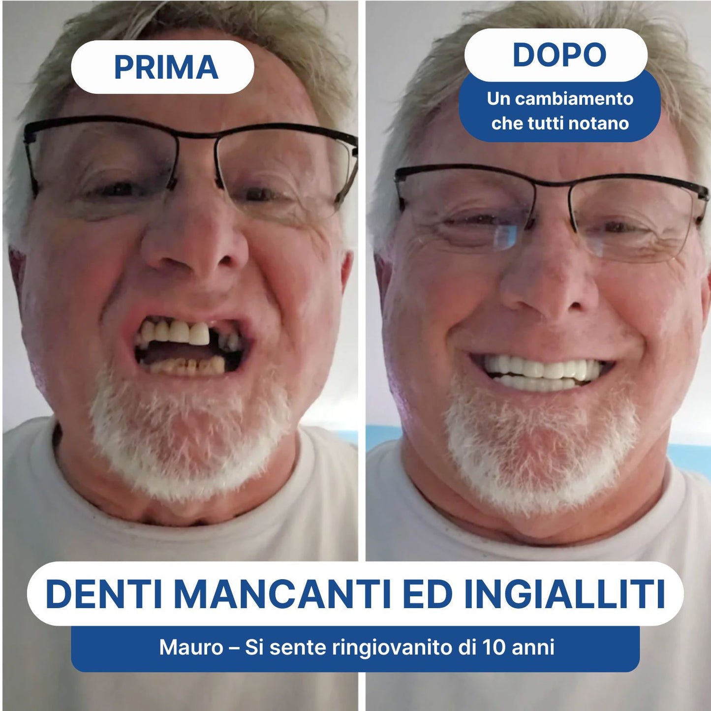 Faccette Dentali Personalizzate – Il Sorriso Che Hai Sempre Desiderato