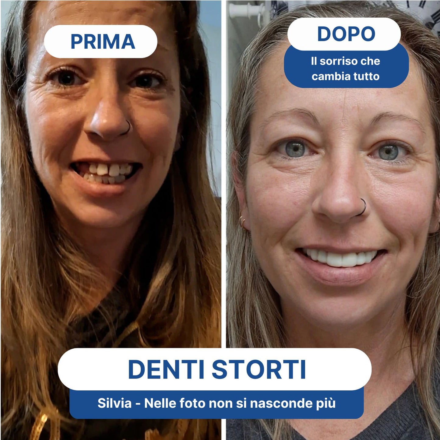 Faccette Dentali Personalizzate – Il Sorriso Che Hai Sempre Desiderato