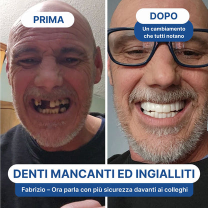 Faccette Dentali Personalizzate – Il Sorriso Che Hai Sempre Desiderato