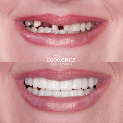 Faccette Dentali Personalizzate – Il Sorriso Che Hai Sempre Desiderato