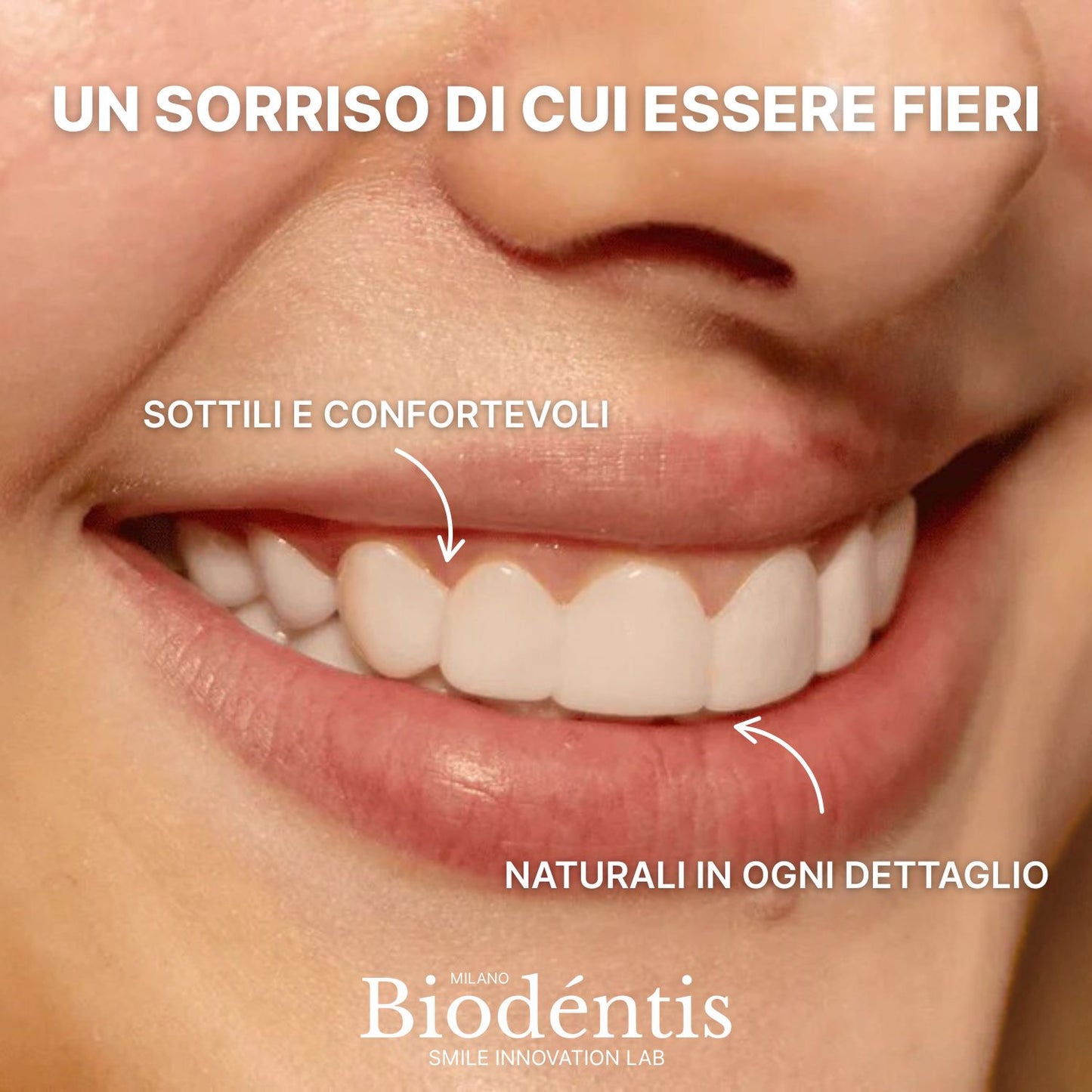 Faccette Dentali Personalizzate – Il Sorriso Che Hai Sempre Desiderato