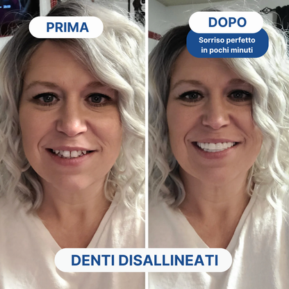 Faccette Dentali Personalizzate – Removibili e su Misura