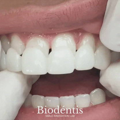 Faccette Dentali Personalizzate – Il Sorriso Che Hai Sempre Desiderato